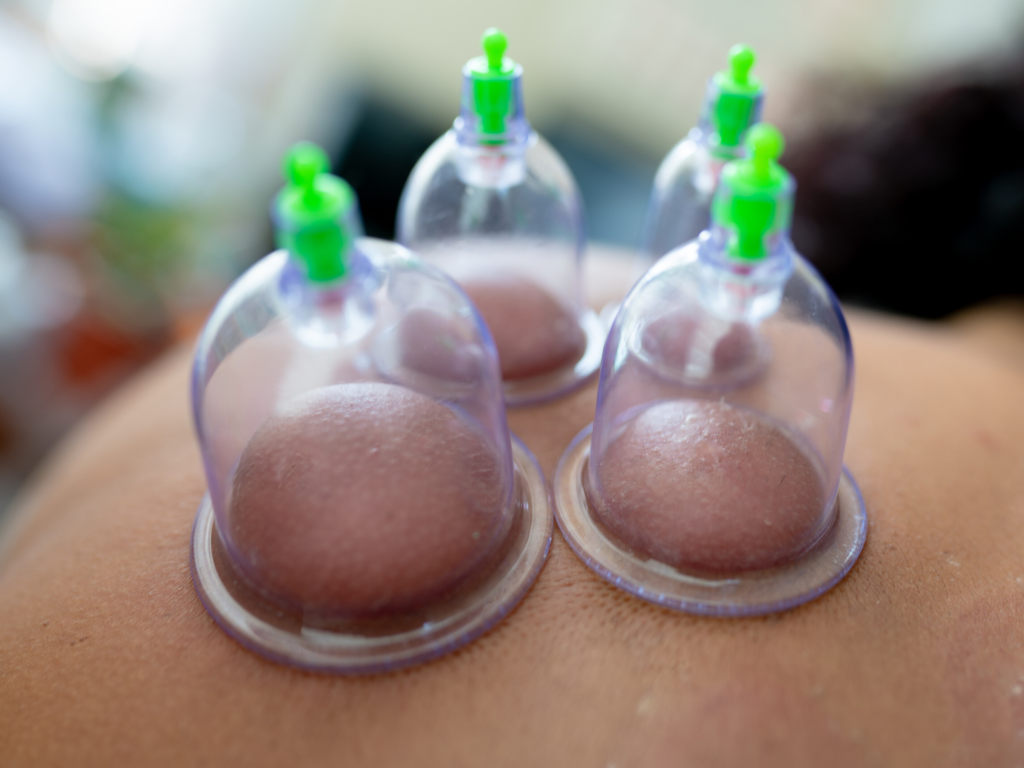 hijama gevaarlijk